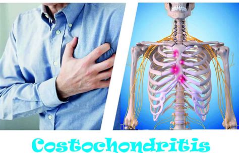 Costochondritis - Causes, Symptoms, Locations, Duration & Treatment