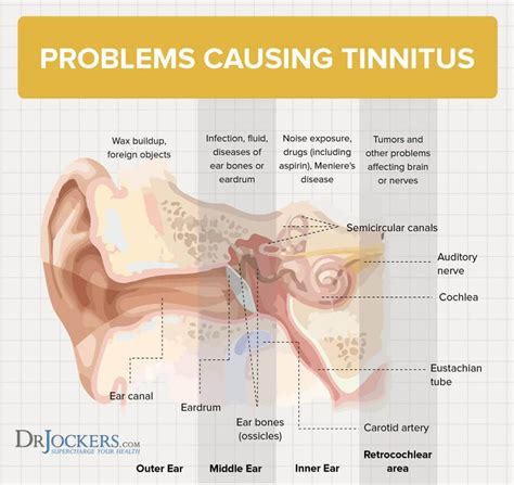 Tinnitus symptoms causes and natural support strategies – Artofit