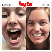 Byte Before & After Photos: Pics of Real Customer Results