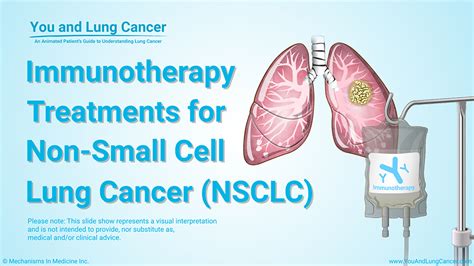 Slide Show - Immunotherapy Treatments for Non-small Cell Lung Cancer (NSCLC)