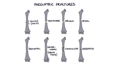 Fractures – Zero To Finals