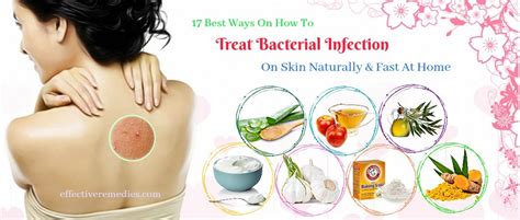 17 Best Ways How To Treat Bacterial Infection On Skin At Home