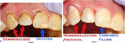 Remineralization is Real: reversing bracket scars and discolored roots – McFarlane Dental