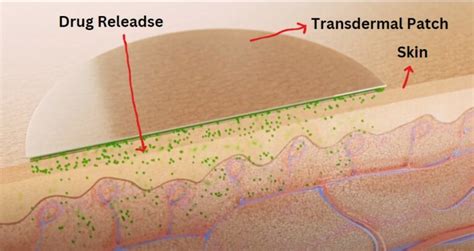 Transdermal Patches: Working, advantages, applications, and types ...