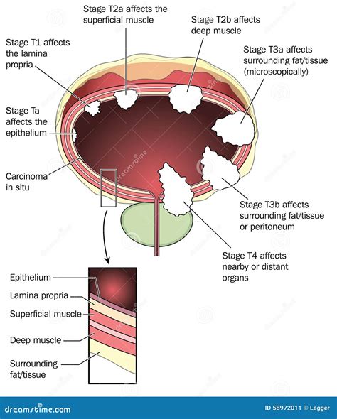 Bladder Cancer: Stages Of Bladder Cancer