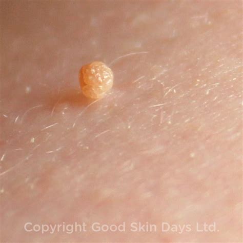 Top 103+ Images Skin Tags And Warts Photos Latest 09/2023