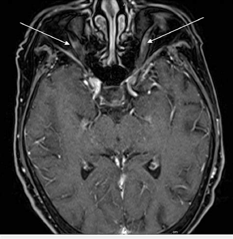 Patient's head MRI with abnormal enhancement of optic nerves. MRI:... | Download Scientific Diagram