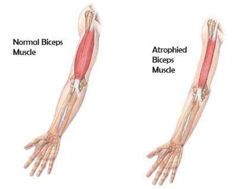 Are you Suffering from Muscle Atrophy? | hubpages