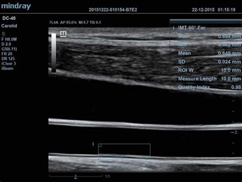 IMT of Common Carotid Artery – Northwest Ultrasound