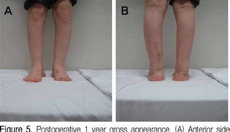 Figure 7 from Treatment of Calcaneovalgus Deformity Following Operative Treatment of Diplegic ...