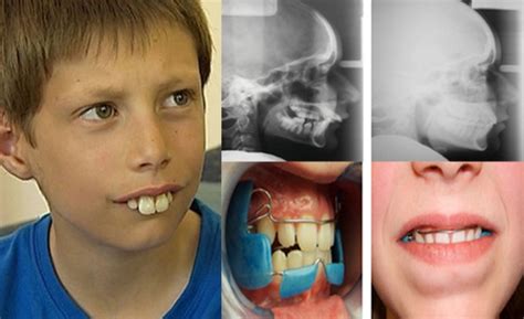 Buck Teeth Pictures, Symptoms and Treatment - Headgear Braces