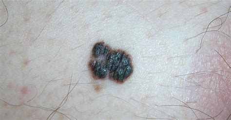 Melanoma Skin Cancer Survival Rate