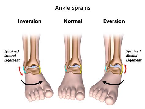 Types Of Foot Injury Ankle at Kenneth Parks blog