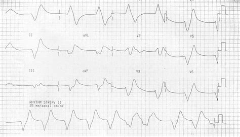 Pin on ECG 11