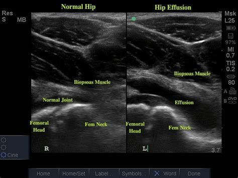 Hip Effusion | Emory School of Medicine