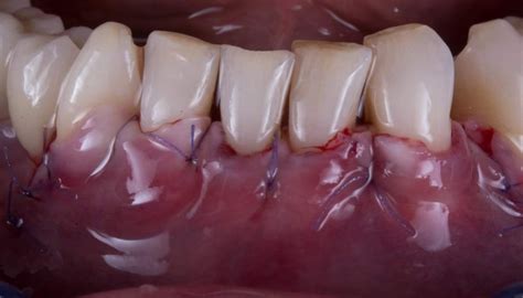 VIDEO NOTES OF MUCOGINGIVAL SURGERY - Mastering Dentistry