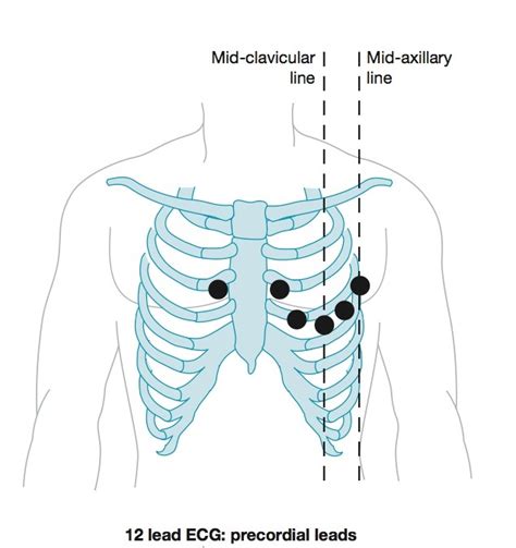 ID the correct Placement of Precordial Leads Diagram | Quizlet