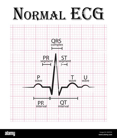 Normal ECG ( Electrocardiogram ) ( P wave , PR segment , PR interval , QRS complex , QT interval ...