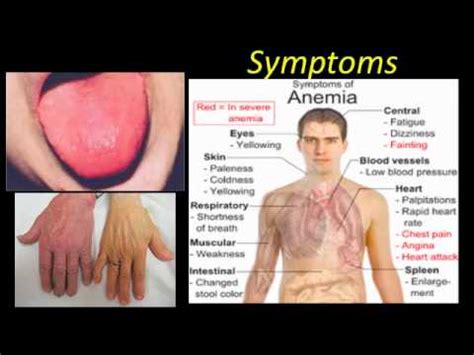 Symptoms Of: Anemia Symptoms