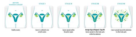 Ovarian Cancer - Physiopedia