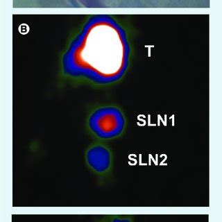 Mobile-camera detection of the sentinel lymph node(s) during sentinel... | Download High-Quality ...