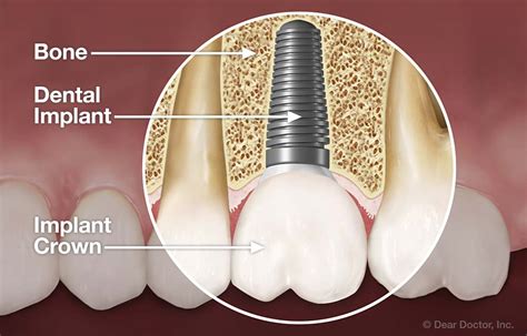 Dental Implants | Dr. P. Bekal DDS | Dayton Ohio