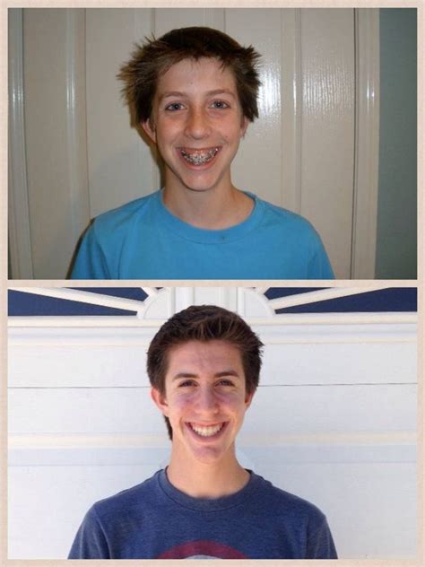 Before and after braces. 4 years is a long time... : r/PastAndPresentPics