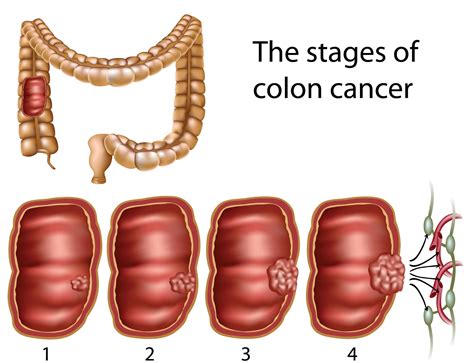 Colon Cancer Treatment: Colorectal Cancer Stages and Treatment Options