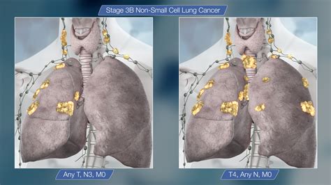 Small Cell Lung Cancer: January 2015