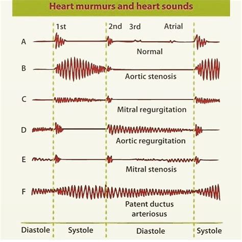 the different types of heartbeats and heart sounds