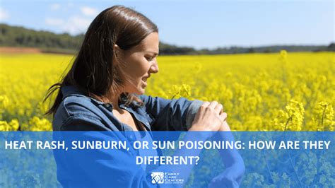 Heat Rash, Sunburn, or Sun Poisoning: How Are They Different?