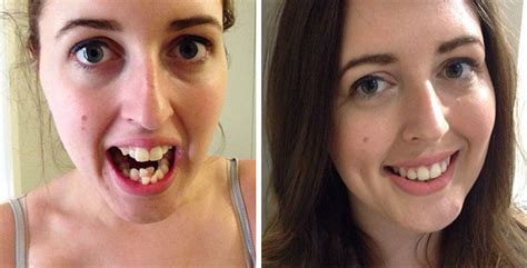 114 Incredible Before & After Transformations Of People Who Wore Braces | Bored Panda