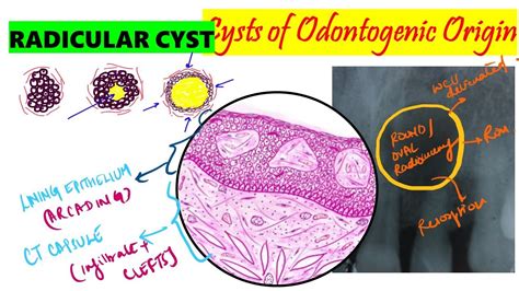 Radicular Cyst Periapical Cyst Histopathology Clinical Features | Porn Sex Picture