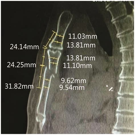 Broken Sternum X Ray