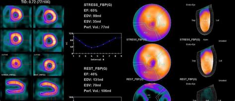 Myocardial perfusion scan | I-MED Radiology Network