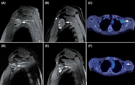 Case 2. (A, B) MRI brachial plexus. Sagittal T1 post-contrast and T2... | Download Scientific ...