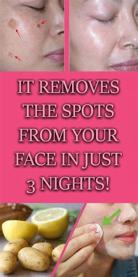 Natural Home Remedy To clear Your Skin Of Dark Spots Or Hyperpigmentation (With images) | Spots ...