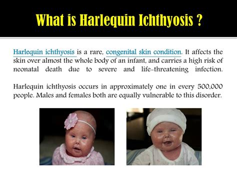 PPT - Harlequin Ichthyosis: Causes, symptoms, complications and ...