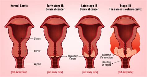 Cervical Cancer Stages | Prof Andreas Obermair » Professor Andreas Obermair