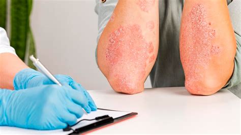 Skin Rash Or Eczema? Expert Helps You Find Out The Difference | OnlyMyHealth