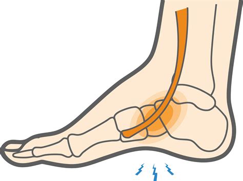 What is Extensor Tendonitis of the Foot & How to Treat It? - Upswing Health