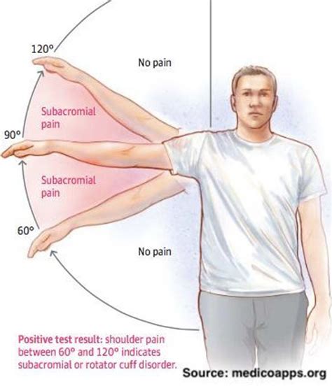 Wizard reader international rotator cuff tendinosis symptoms plans ...