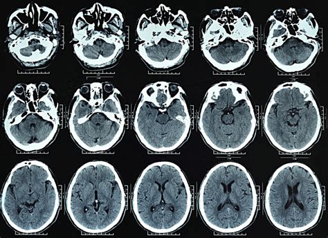 What is a Skull CT scan? | Two Views