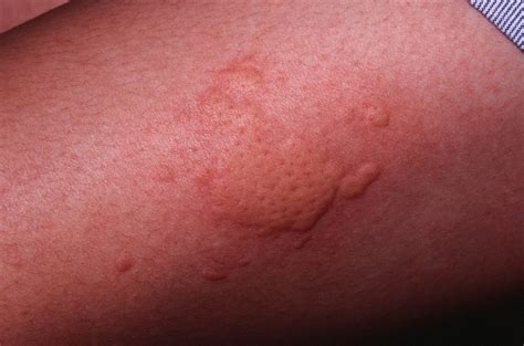 Chronic Hives - Causes, Symptoms, and Treatment