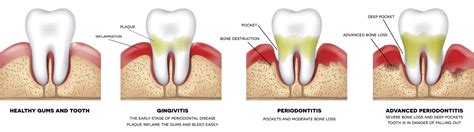 Gum Disease Treatment in Virginia Beach, VA