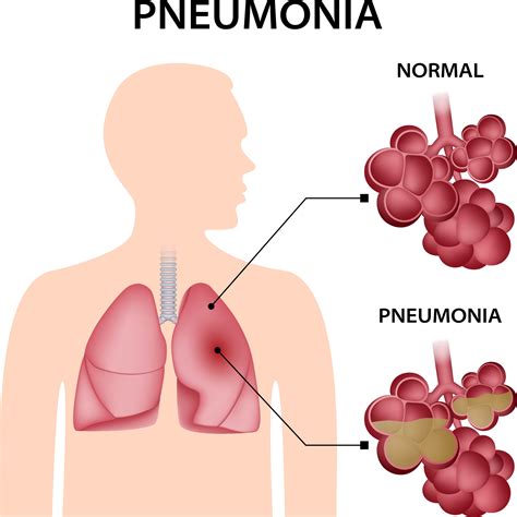 Pneumonia concept background. Realistic illustration of pneumonia ...