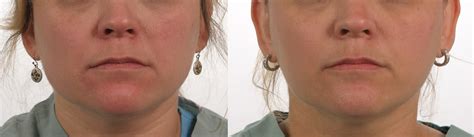 Botox for TMJ - Charleston Facial Plastic Surgery