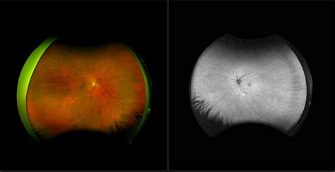 California - Choroidal Nevus, RG, AF