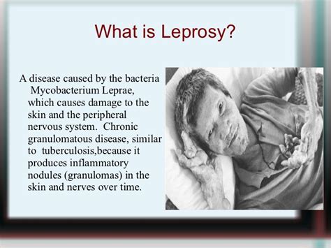 Leprosy