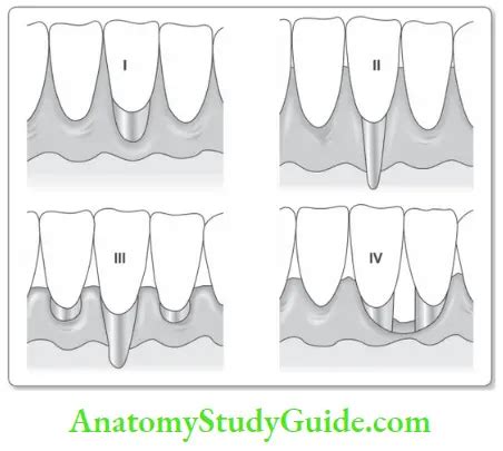 Mucogingival Surgery Question And Answers - Anatomy Study Guide